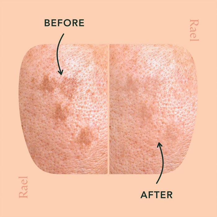 Rael Beauty Miracle Microcrystal Acne Dark Spot Cover Pimple Patch - 6ct