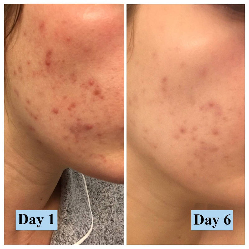 PanOxyl 4% Creamy Facial Treatment Wash - 6oz - EXP 09/2023