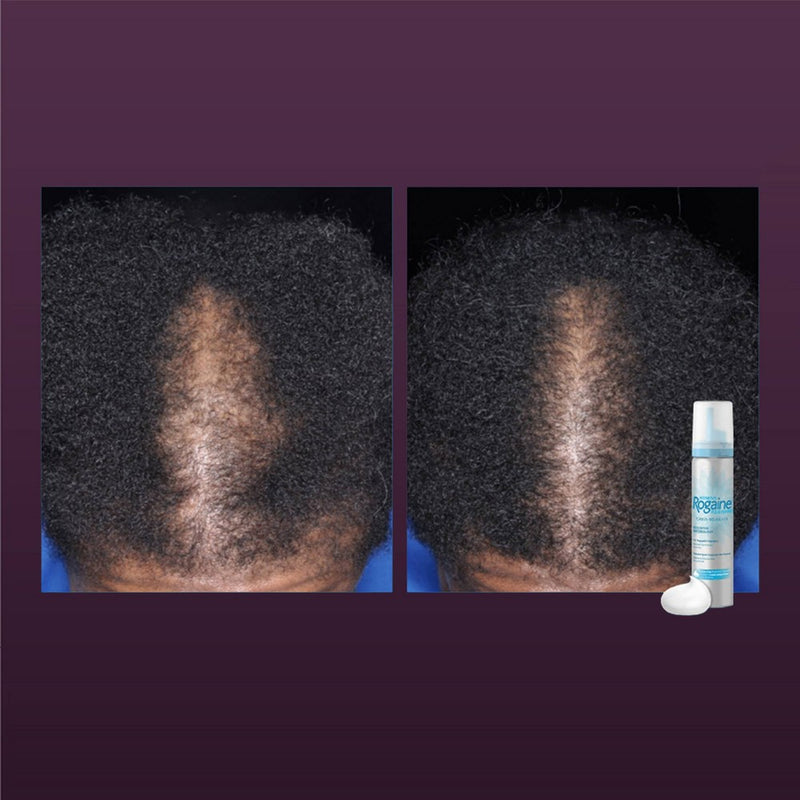 Women's Rogaine 5% Minoxidil Foam for Hair Regrowth - 2.11oz EXP. 07/2024