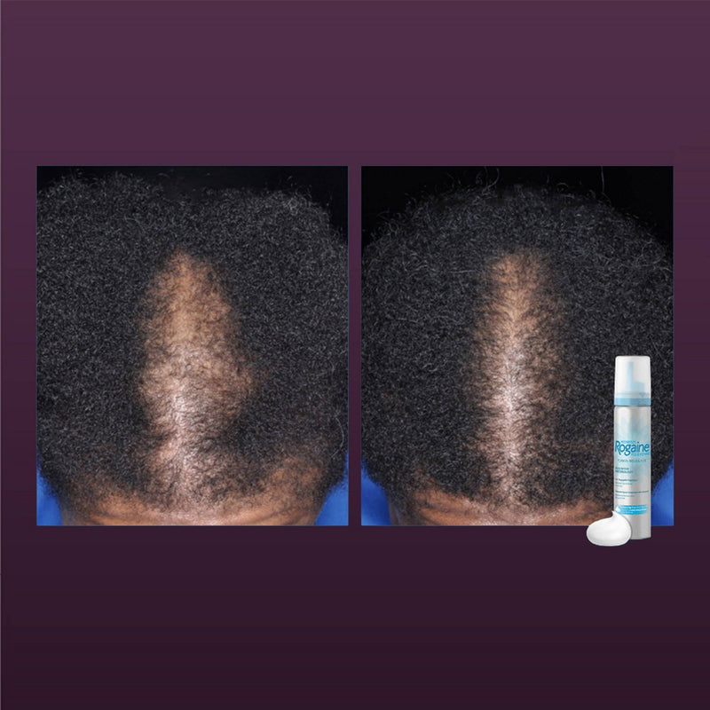 Women's Rogaine 5% Minoxidil Foam for Hair Regrowth - 2.11oz EXP. 07/2024