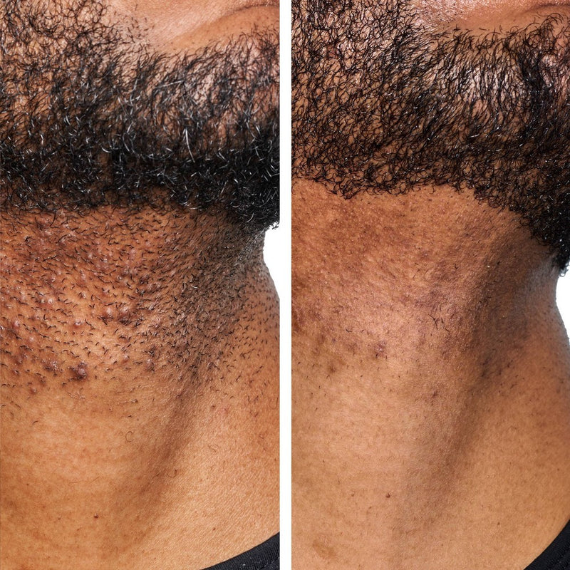 Urban Skin Rx Men's Daily Razor Bump + Dark Spot Treatment - 1.7 fl oz
