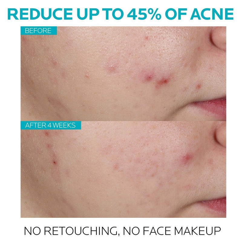 La Roche Posay Acne Treatment Salicylic Acid Face Serum - 1oz EXP 12/25 or later