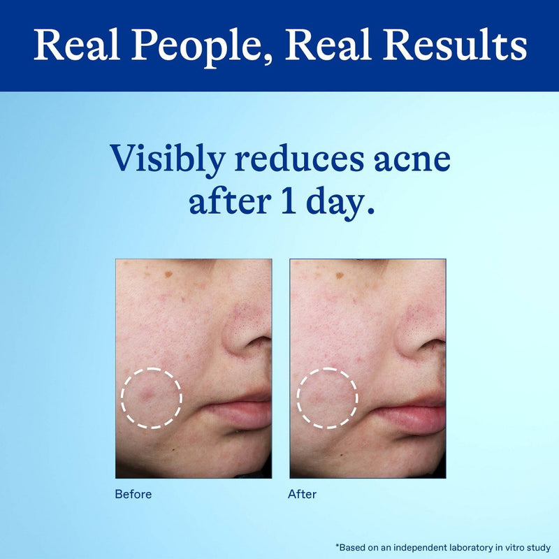 Differin 10% Benzoyl Peroxide Acne Spot Treatment EXP 02/2027