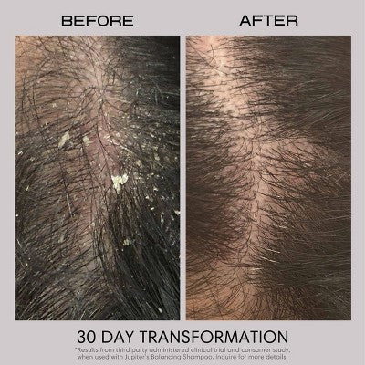 Jupiter Anti-Dandruff Restoring Scalp Serum - 2.1 fl oz