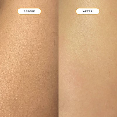 Nood Ingrown Hair Treatment - The Eraser