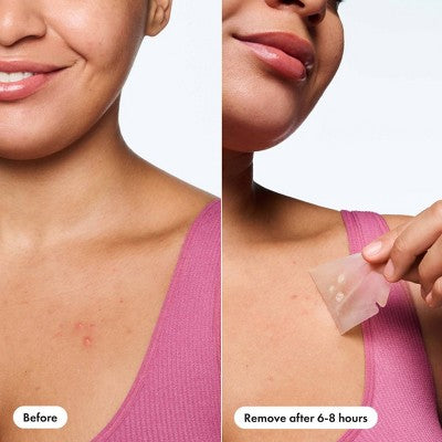 Hero Cosmetics Mighty Patch Body Patch - 4ct: Alcohol-Free, Whole Body Application, Acne-Prone Skin