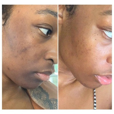 Urban Skin Rx 3-in-1 Combination Skin Cleansing Bar - 2oz
