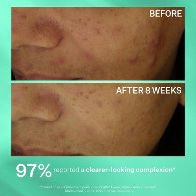 StriVectin Multi-Action Clear Acne Control System - Ulta Beauty: For Combination, Acne-Prone Skin, Includes Cleanser, Toner, Lotion