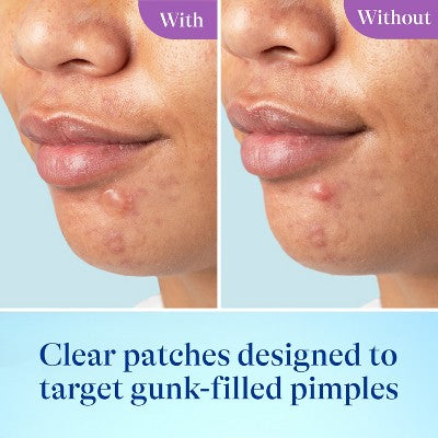 Differin Skin Restore Hydrocolloid Pimple Patches for Acne - 23ct