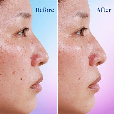 Differin Dark Spot Correcting Serum for Acne Prone Skin - 1 fl oz