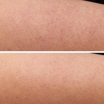 Strivectin KP Care Bump Exfoliating Body Scrub - 5 oz - Ulta Beauty: Whole Body, Tube, Normal Skin, Skin Texture Improvement