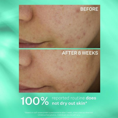 StriVectin Multi-Action Clear Acne Control System - Ulta Beauty: For Combination, Acne-Prone Skin, Includes Cleanser, Toner, Lotion